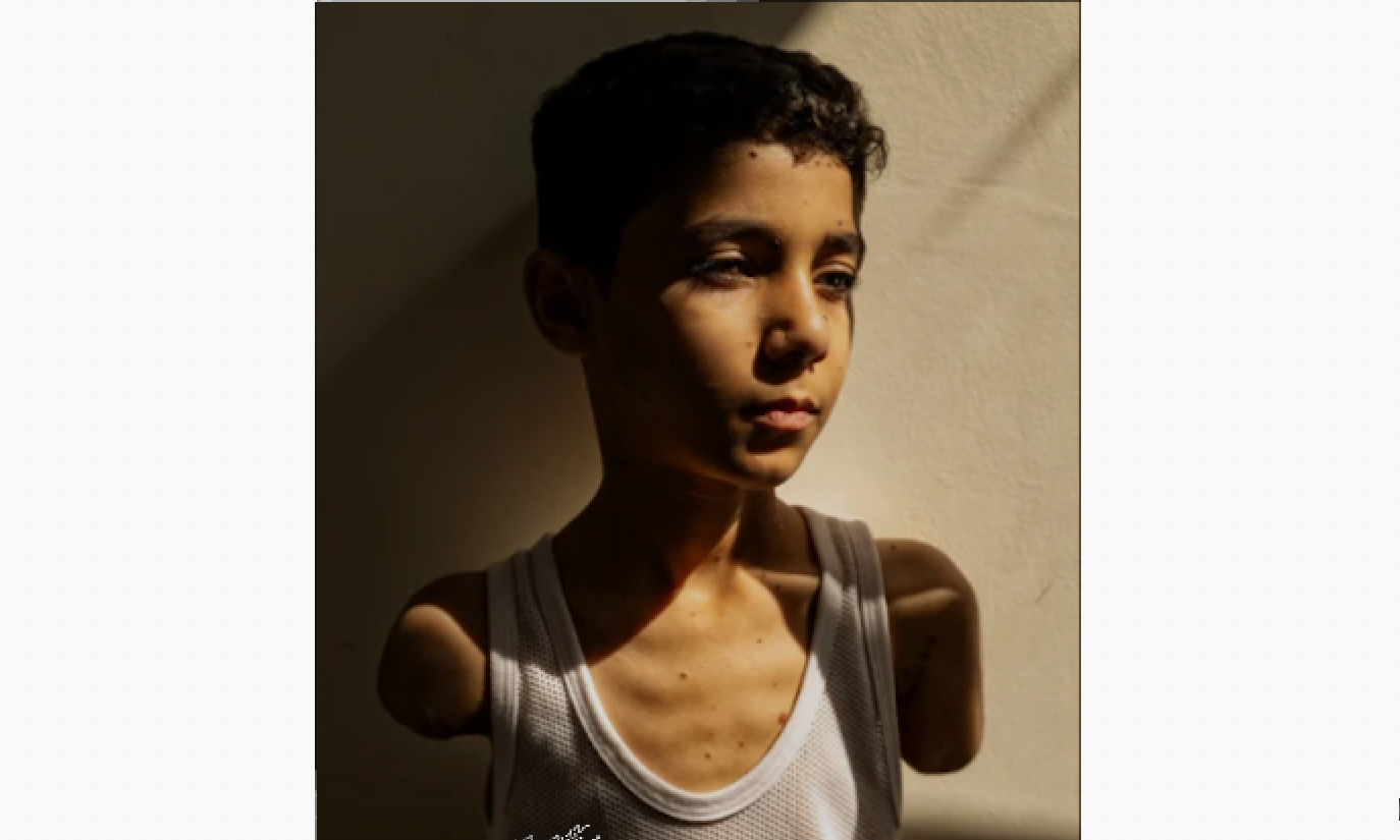 Bei einem israelischen Luftangriff verlor dieser 9-Jährige beide Arme. Das Bild wurde 2025 zum World Press Photo. Unterdessen lebt der Bub mit Prothesen in Katar.