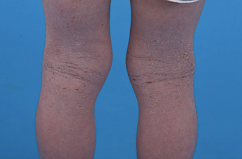 Atopische Dermatitis