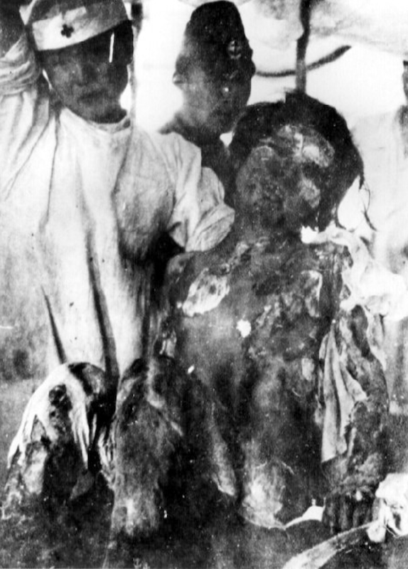 Schwerverletzte Schülerin in Nagasaki 1945