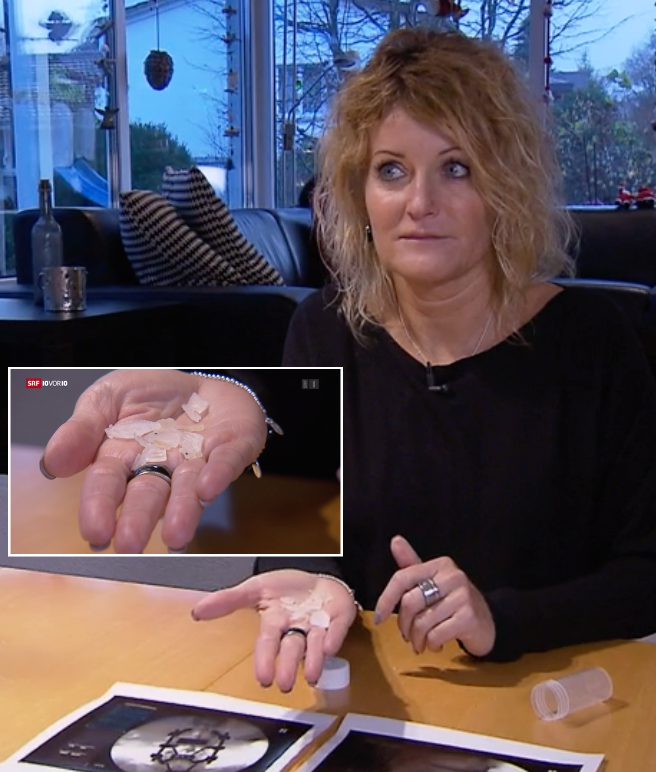 Manuela E. Patientin von Aebi Implantat nach 4 Jahren im Rücken 3