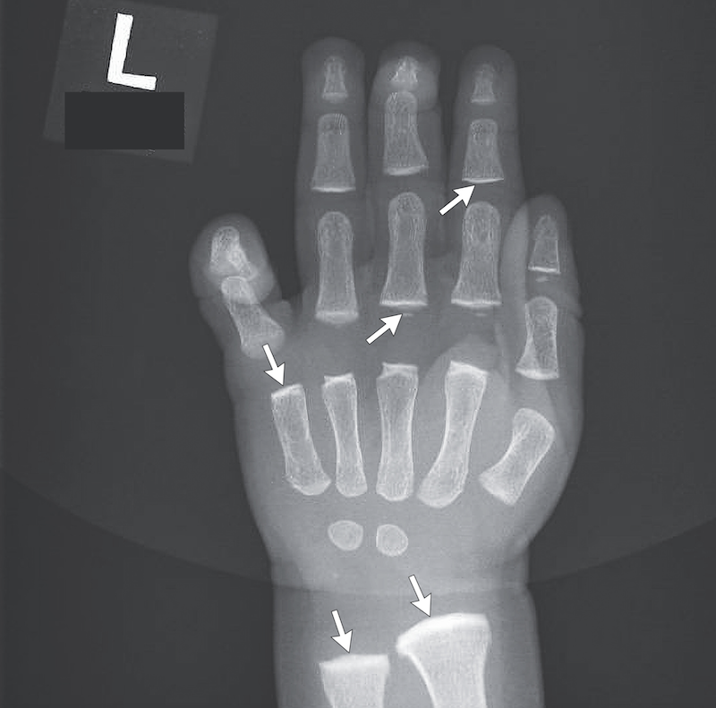 Röntgenbild linke Hand Baby